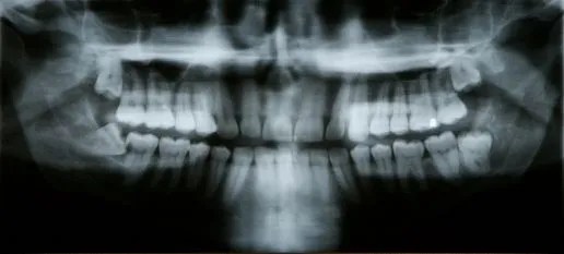 A panoramic dental X-ray (orthopantomogram) providing a wide view of the upper and lower jaws, teeth, and surrounding joints and bones in a single flat image.