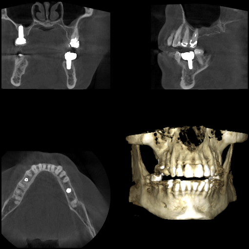 A dental CBCT scan display showing multiple views of the jaw. The images highlight several dental implants appearing as bright white structures integrated into the bone across different anatomical planes and 3D rendering.