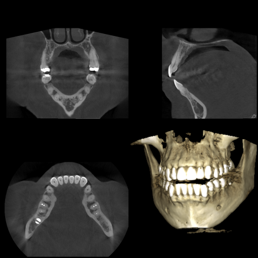 A Cone Beam Computed Tomography (CBCT) display showing four panels: three grayscale cross-sectional views of the jaw and one 3D color reconstruction of the skull and teeth for detailed diagnostic planning.